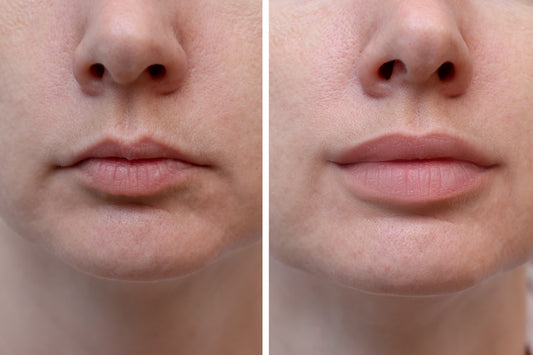 Lip Filler | Frequently Asked Questions & Answers
